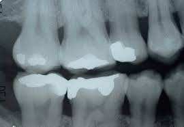 amalgam removal protocol