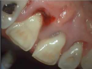 PERIODONTAL DISEASE