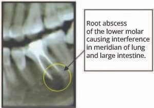 Root Abscess natural dentistry