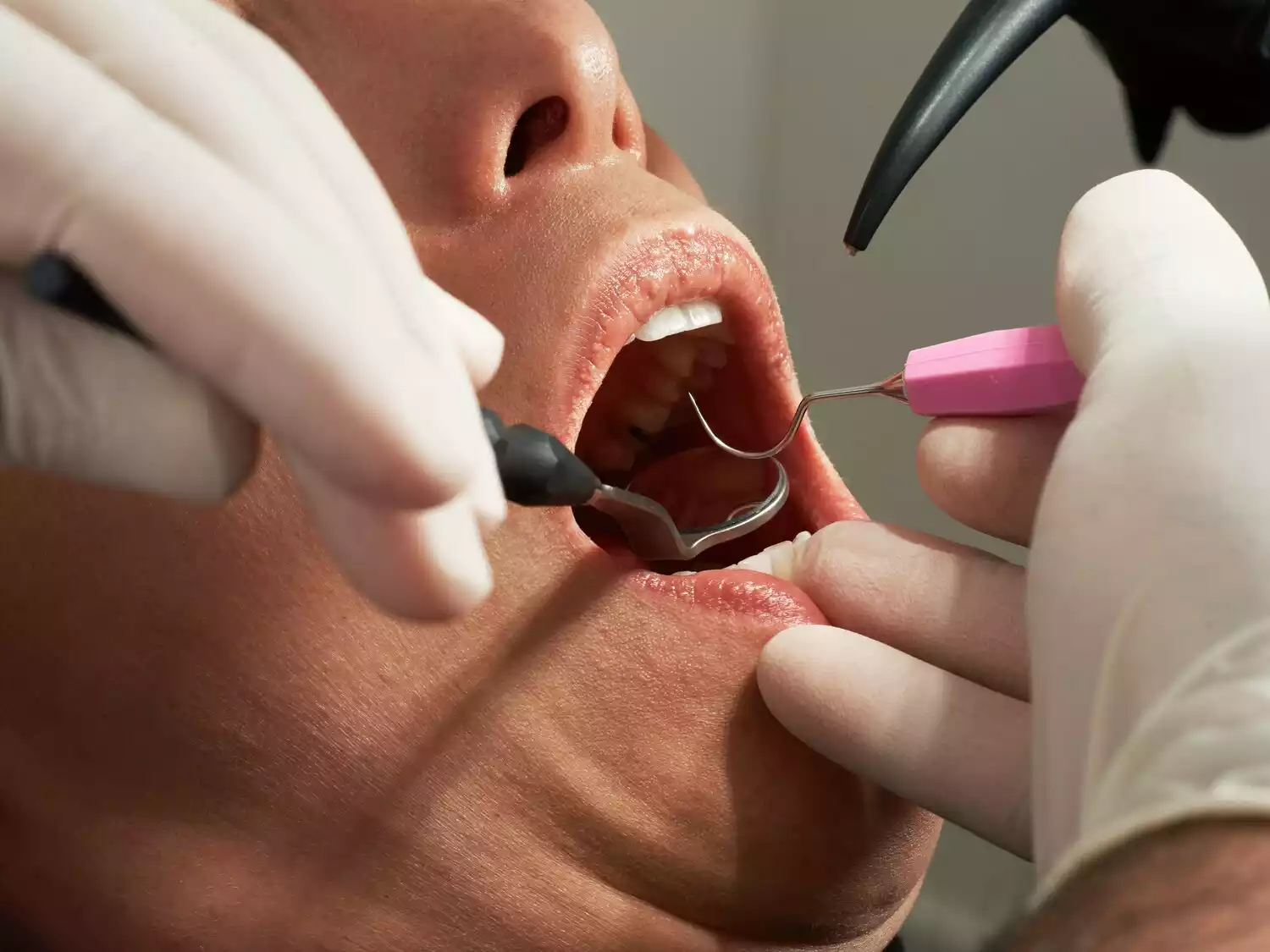 are amalgam fillings safe